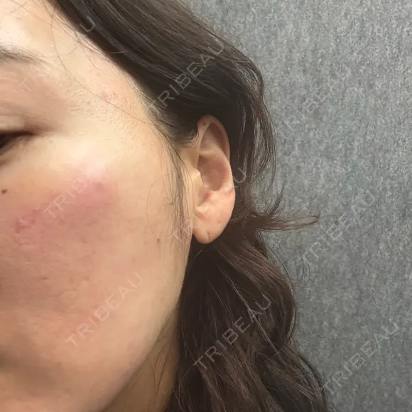 ハイフ（顔） Natural Skin Clinic 自由ヶ丘院 AFTER メイン用