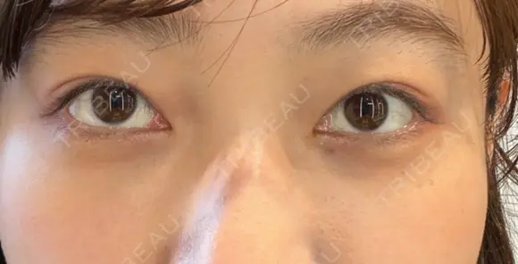 クマ治療 / 下まぶたたるみ取り / 下まぶたの脂肪取り 新宿美容外科ネビュラクリニック AFTER メイン用