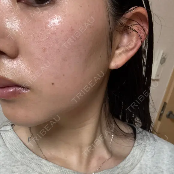 イオン導入 / 毛穴洗浄（ハイドラフェイシャルなど） / ルメッカ ルラ美容クリニック 岡山院 DAY 14 メイン用