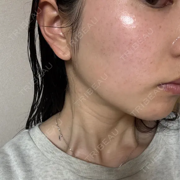 イオン導入 / 毛穴洗浄（ハイドラフェイシャルなど） / ルメッカ ルラ美容クリニック 岡山院 DAY 14 メイン用