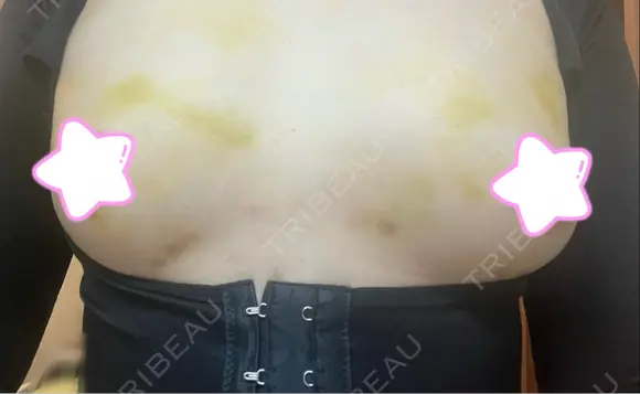 豊胸（脂肪注入） 銀座マイアミ美容外科 DAY 8 メイン用