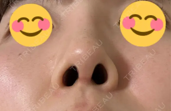 鼻尖形成（切開） / 鼻中隔延長（切開） / 軟骨移植 / 眉間プロテーゼ eクリニック 福岡院 DAY 55 メイン用