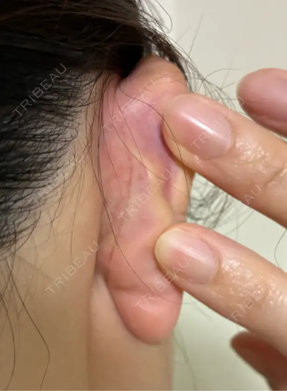 鼻尖形成（切開） / 鼻中隔延長（切開） / 軟骨移植 / 眉間プロテーゼ eクリニック 福岡院 DAY 55 メイン用