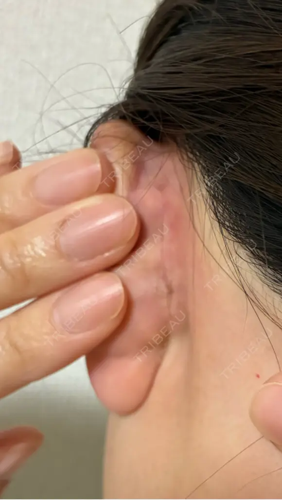 鼻尖形成（切開） / 鼻中隔延長（切開） / 軟骨移植 / 眉間プロテーゼ eクリニック 福岡院 DAY 55 メイン用