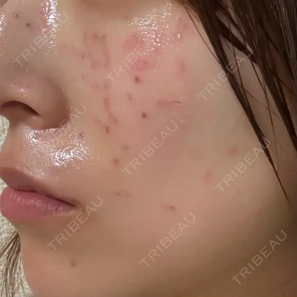 ピコスポット G MEDICAL ART クリニック 新宿院 DAY 1 メイン用