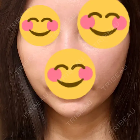 エレクトロポレーション / RF（高周波）たるみ治療 Days Beauty Clinic 新宿院 DAY 6 メイン用