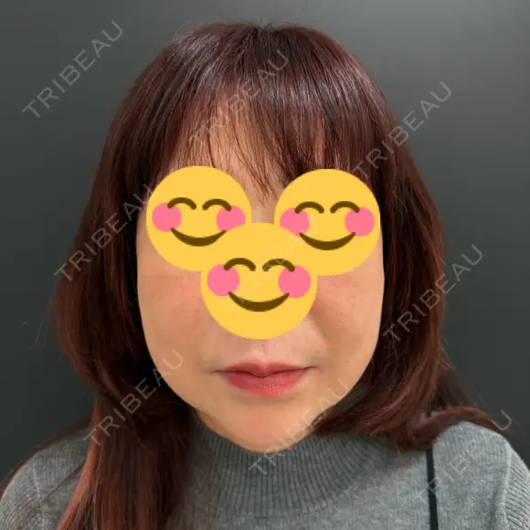 糸リフト / ボトックス（あご） / ヒアルロン酸注入（唇） / ボトックス（眉間） / ボトックス（目尻） eクリニック 那覇院 AFTER メイン用