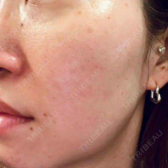 光治療（フォトフェイシャルなど） しんゆり美容健康クリニック AFTER メイン用