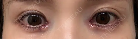 目頭切開 / ヒアルロン酸注入（涙袋） / ボトックス（あご） / ベビーコラーゲン AI Beauty Clinic （エーアイ美容クリニック） DAY 0 メイン用