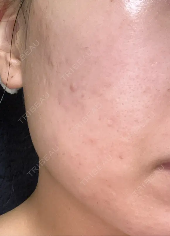 ピーリング（ハリ・ツヤ） / ルメッカ 大美会クリニック 天王寺院 AFTER メイン用