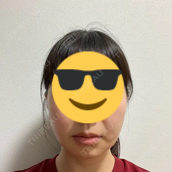 糸リフト / 肌育注射（ジュベルックなど） 東京ココセランクリニック DAY 9 メイン用