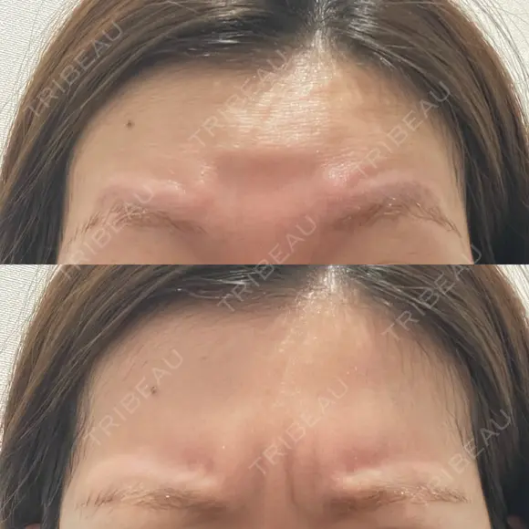 ワキ汗治療（ボトックス） / ボトックス（眉間） J CLINIC DAY 0 メイン用