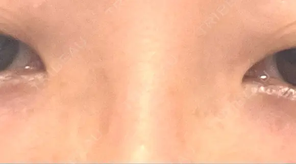 その他（目元） BRIGHTS beauty clinic DAY 4 メイン用