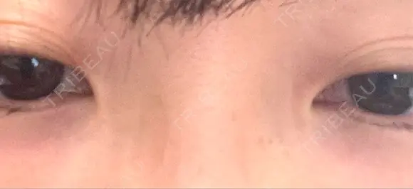 その他（目元） BRIGHTS beauty clinic DAY 5 メイン用