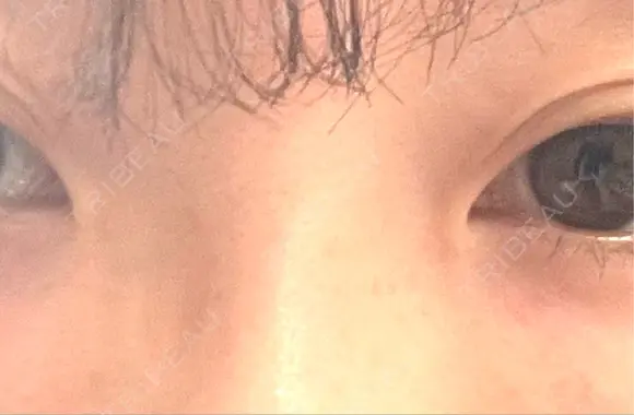 その他（目元） BRIGHTS beauty clinic DAY 10 メイン用