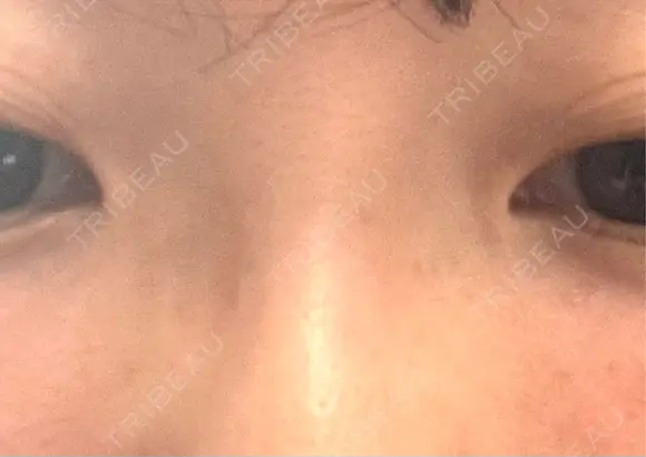 その他（目元） BRIGHTS beauty clinic DAY 11 メイン用