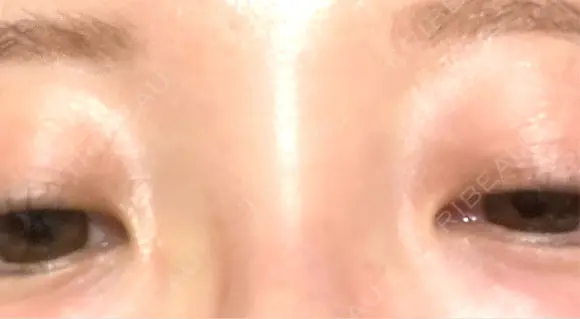 その他（目元） BRIGHTS beauty clinic AFTER メイン用