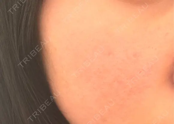 ダーマペン 大美会クリニック 京都烏丸院 AFTER メイン用