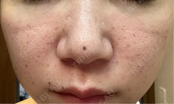 水光注射（ハリ・美肌） エトワールレジーナクリニック新宿院 AFTER メイン用