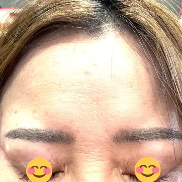 ボトックス（額） ルラ美容クリニック 郡山院 DAY 2 メイン用