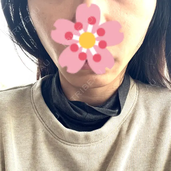 糸リフト / 肌ヒアルロン酸注入（たるみ・シワ改善） BON BON CLINIC 銀座駅前本院 DAY 1 メイン用