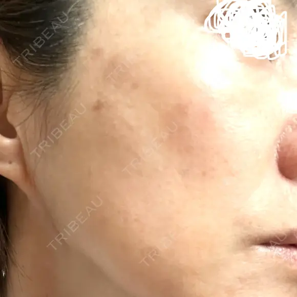 プラセンタ注射 / シミ取りレーザー S-Laboクリニック 渋谷院 AFTER メイン用