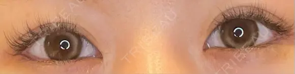 目尻切開 / タレ目形成・グラマラスライン（埋没） LOUIS CLINIC 二子玉川院【ルイクリニック】 AFTER メイン用