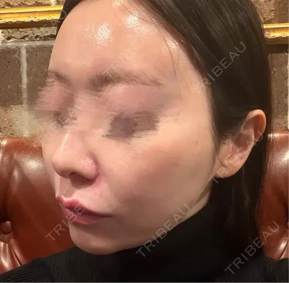 ピコレーザートーニング（美白・肝斑） / LDM・インテンスウルトラ Chloe Cheongdam Clinic （クロエチョンダムクリニック） DAY 0 メイン用