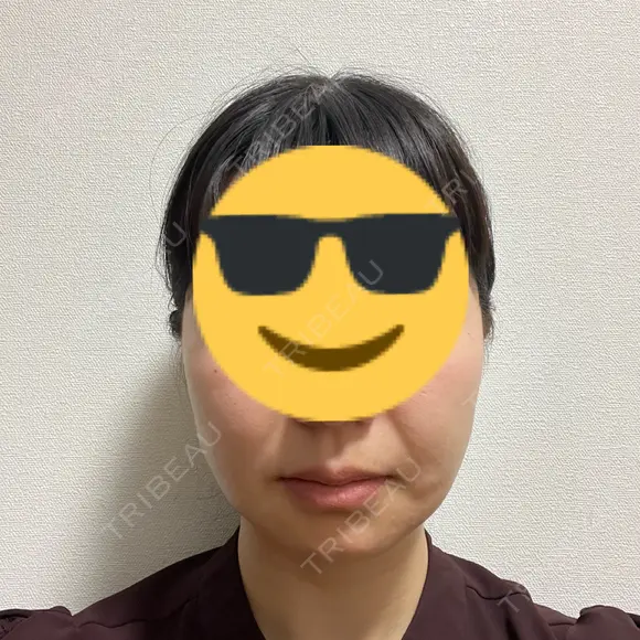 糸リフト / 肌育注射（ジュベルックなど） 東京ココセランクリニック DAY 10 メイン用