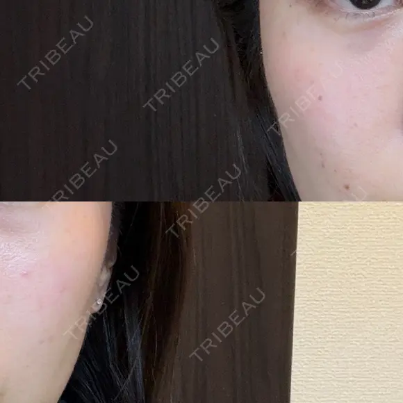 ハイフ（顔） / デンシティ DAILY SKIN CLINIC 新宿院 AFTER メイン用