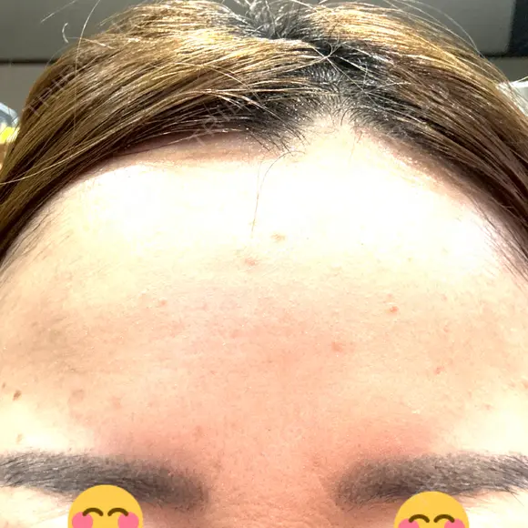 ボトックス（額） ルラ美容クリニック 郡山院 DAY 3 メイン用