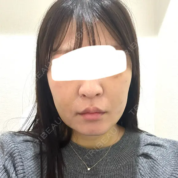 脂肪吸引注射（顔） 新宿美容外科ネビュラクリニック DAY 10 メイン用