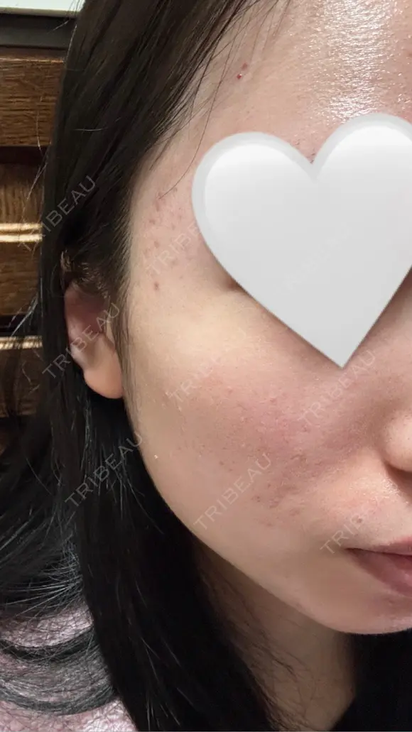 イオン導入 / 毛穴洗浄（ハイドラフェイシャルなど） RIN BEAUTY CLINIC DAY 1 メイン用