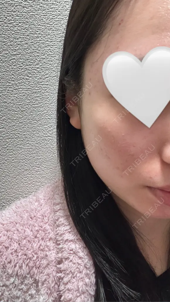 イオン導入 / 毛穴洗浄（ハイドラフェイシャルなど） RIN BEAUTY CLINIC DAY 4 メイン用