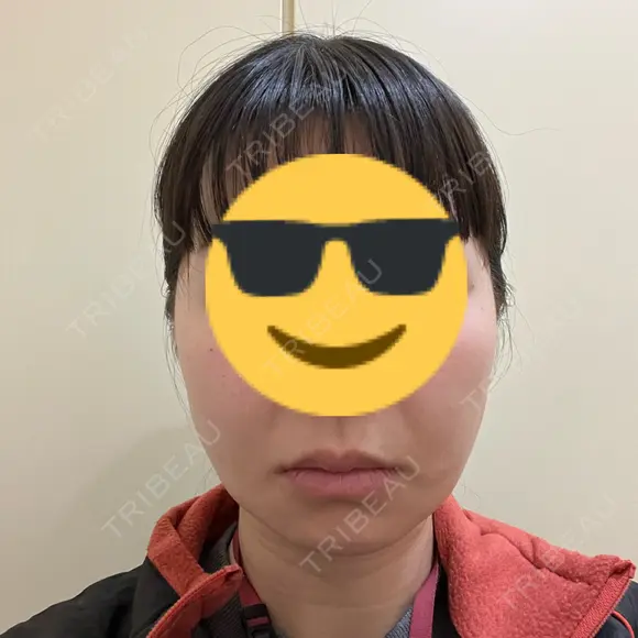 糸リフト / 肌育注射（ジュベルックなど） 東京ココセランクリニック DAY 11 メイン用