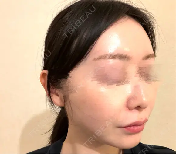 ピコレーザートーニング（美白・肝斑） / LDM・インテンスウルトラ Chloe Cheongdam Clinic （クロエチョンダムクリニック） DAY 1 メイン用