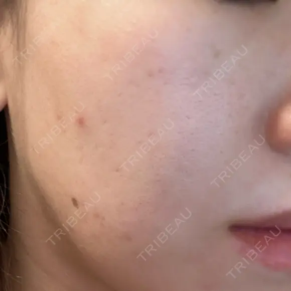 ルメッカ ルラ美容クリニック 郡山院 DAY 10 メイン用