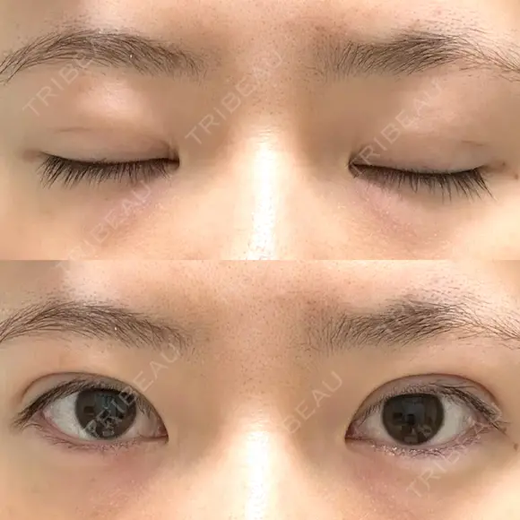 二重埋没 / 上まぶたの脂肪取り アリエル美容クリニック 郡山院 DAY 70 メイン用