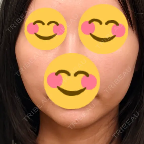 エレクトロポレーション / RF（高周波）たるみ治療 Days Beauty Clinic 新宿院 AFTER メイン用
