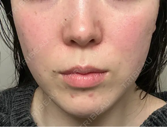 ピーリング（ニキビ・毛穴） / ピーリング（ハリ・ツヤ） / ルメッカ ハナビューティークリニック AFTER メイン用