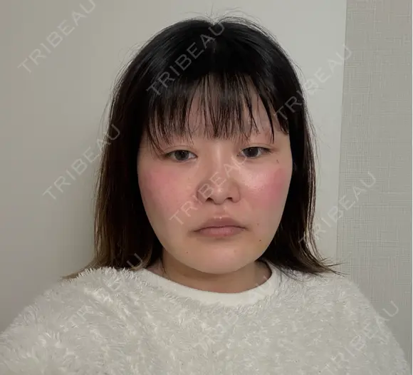 糸リフト / 脂肪吸引（顔） / ボトックス（エラ・小顔） 新宿美容外科ネビュラクリニック AFTER メイン用