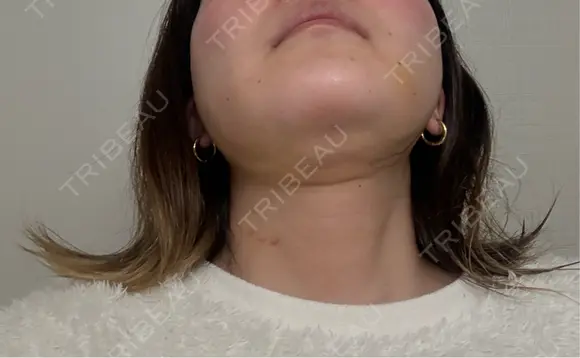 糸リフト / 脂肪吸引（顔） / ボトックス（エラ・小顔） 新宿美容外科ネビュラクリニック DAY 14 メイン用