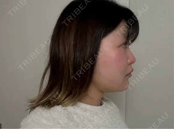 糸リフト / 脂肪吸引（顔） / ボトックス（エラ・小顔） 新宿美容外科ネビュラクリニック DAY 14 メイン用