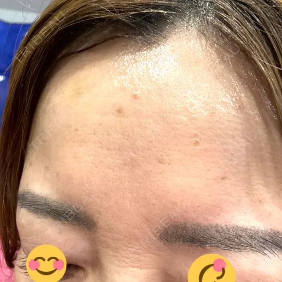 ボトックス（額） ルラ美容クリニック 郡山院 DAY 4 メイン用