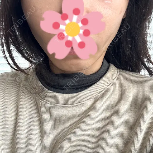 糸リフト / 肌ヒアルロン酸注入（たるみ・シワ改善） BON BON CLINIC 銀座駅前本院 AFTER メイン用