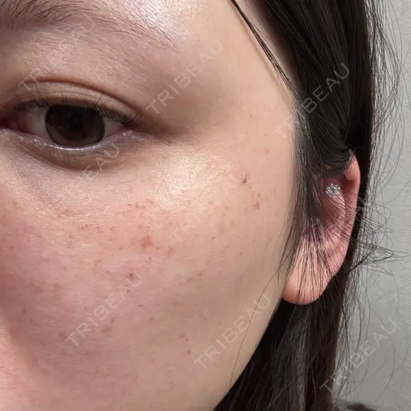 ルメッカ ルラ美容クリニック 岐阜院 AFTER メイン用