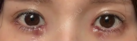 目頭切開 / ヒアルロン酸注入（涙袋） / ボトックス（あご） / ベビーコラーゲン AI Beauty Clinic （エーアイ美容クリニック） AFTER メイン用