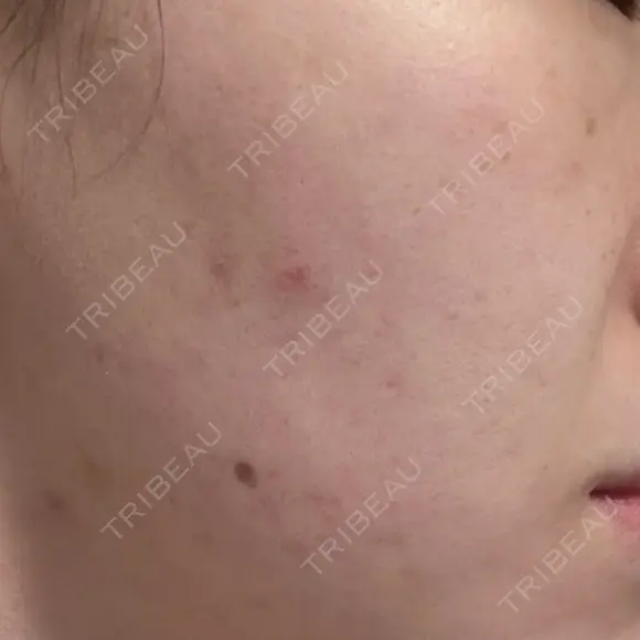 ルメッカ ルラ美容クリニック 郡山院 DAY 11 メイン用