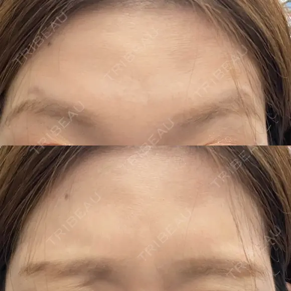 ワキ汗治療（ボトックス） / ボトックス（眉間） J CLINIC AFTER メイン用