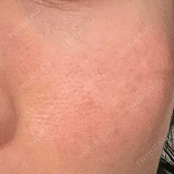 その他（目元） 品川スキンクリニック広島院 AFTER メイン用